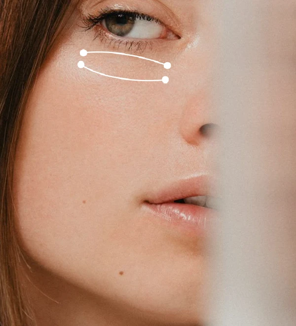 Blefaroplastia Monterrey